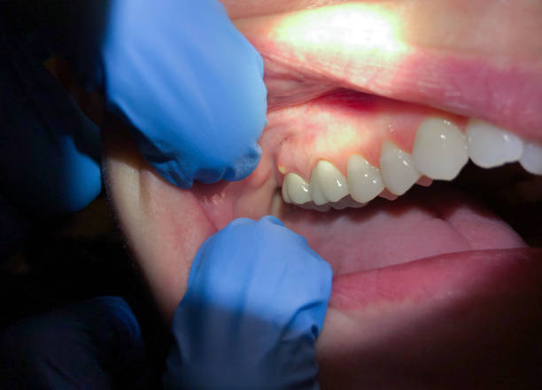 Best Emergency Dentist for Knocked-Out Tooth in Elwood, KS